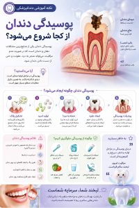 پوسیدگی دندان از کجا شروع میشود؟ دندانپزشکی دکتر نگار عطاءاللهی