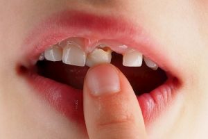 علائم نیاز به مراجعه به دندانپزشک لق شدن دندان دکتر نگار عطاءاللهی شیراز