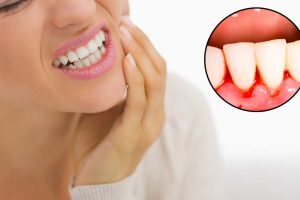 علائم نیاز به مراجعه به دندانپزشک خونریزی لثه دکتر نگار عطاءاللهی شیراز