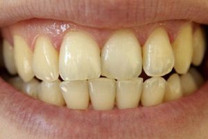 علائم نیاز به مراجعه به دندانپزشک تغییر رنگ دندان دکتر نگار عطاءاللهی شیراز